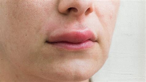 allergic reaction that makes lips swelling fall